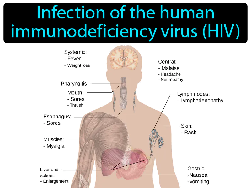 AIDS Definition AIDS Definition