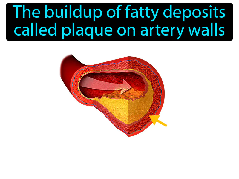 Atherosclerosis Definition
